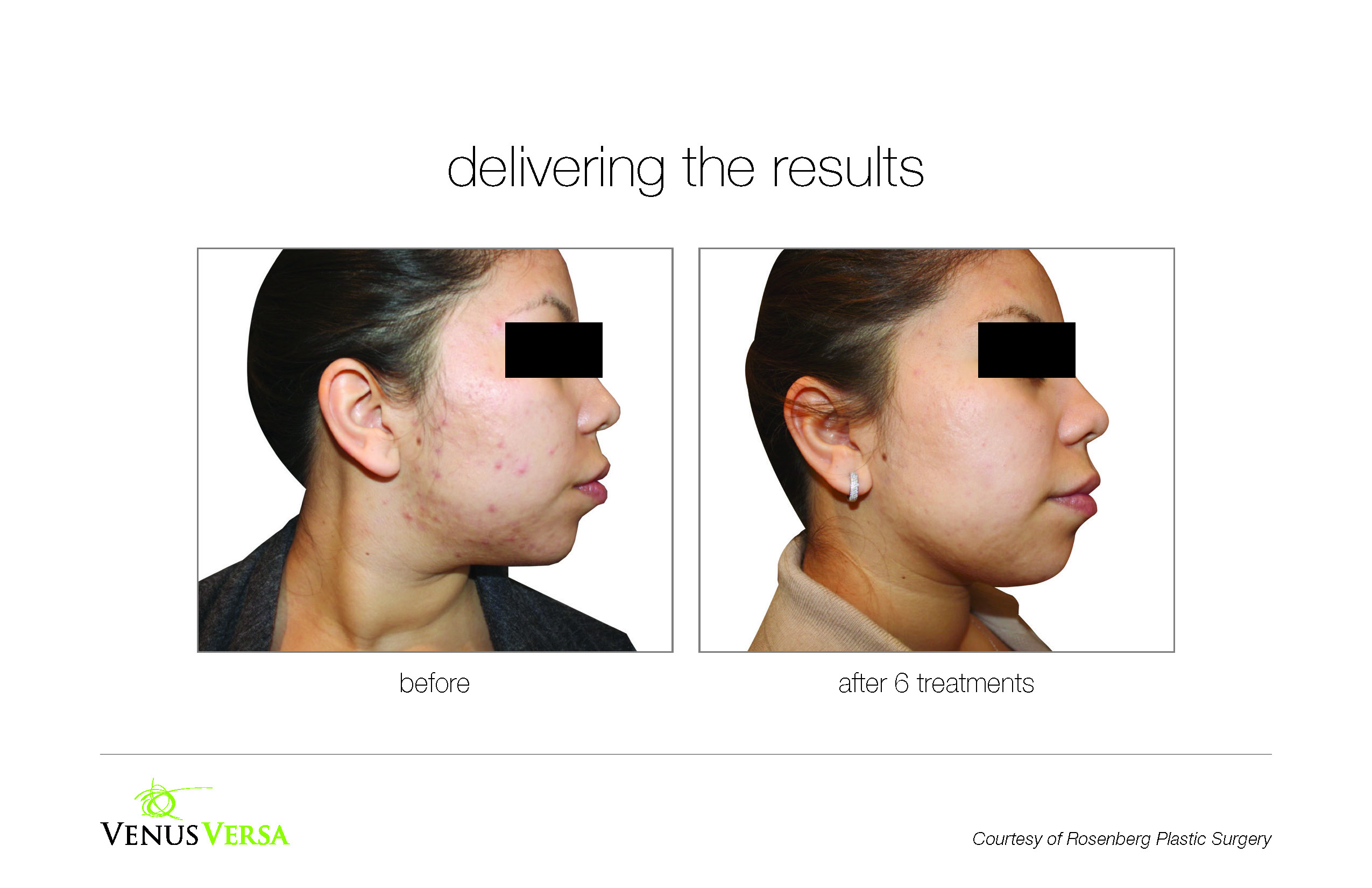 VenusVersa_B&A_Acne_RosenbergPlasticSurgery_6Tx