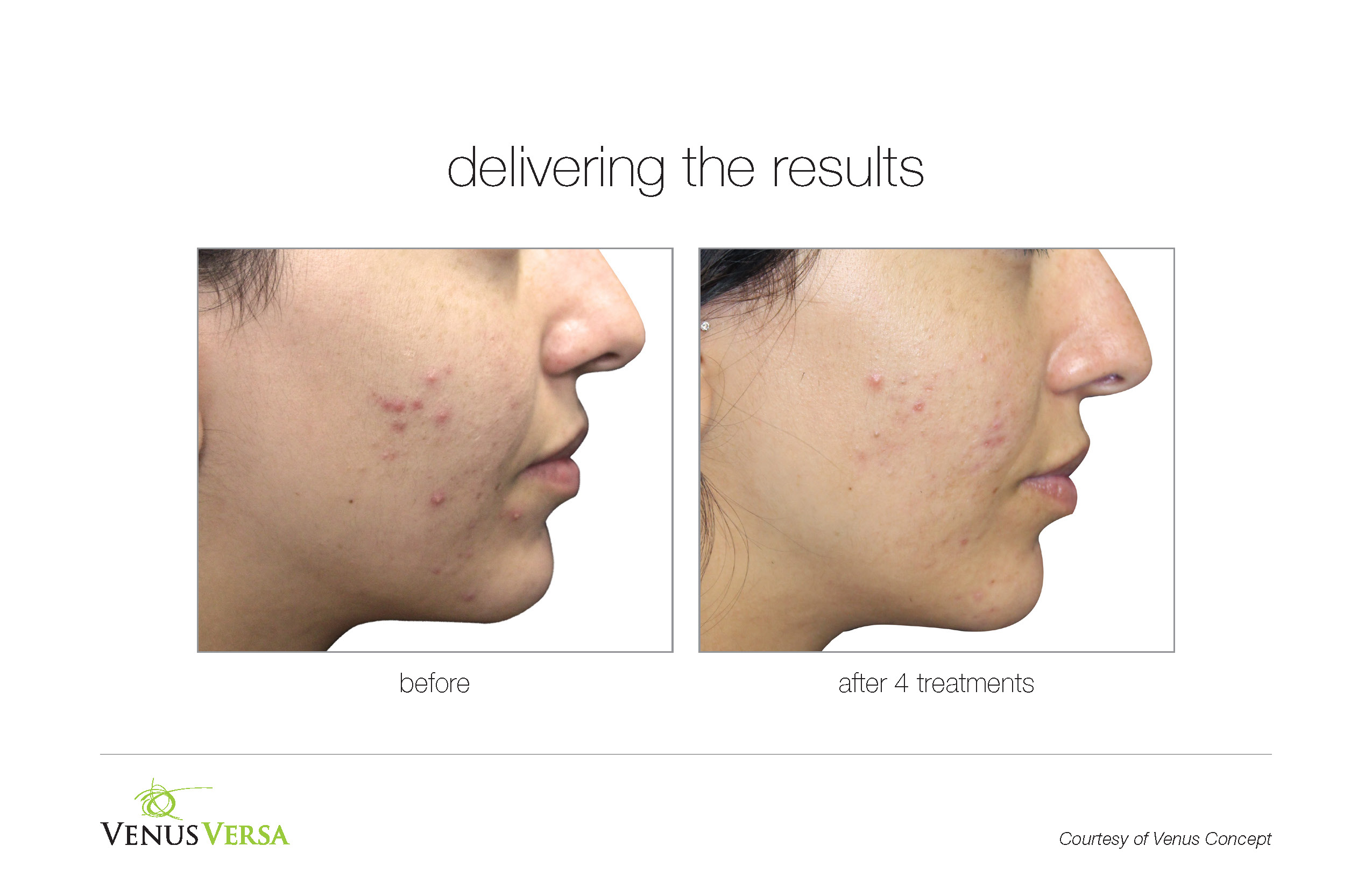 VenusVersa_B&A_Acne_VenusConcept_4Tx